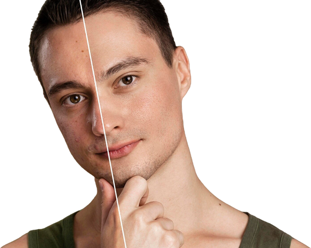 Side-by-side comparison of a coLaz patient's skin before and after a course of Dermapen microneedling