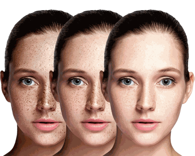PICO Laser Treatment treatment at a CoLaz clinic