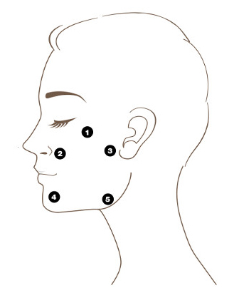 Five-point Bio-Aesthetic Points map for Profhilo on a side-profile face diagram